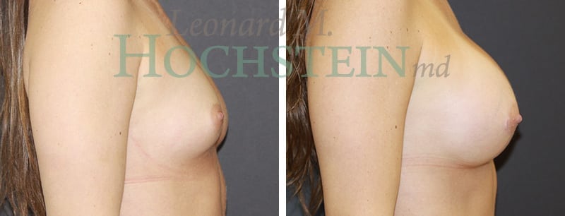 Breast Augmentation Patient