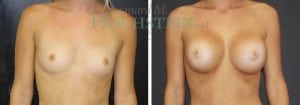 Breast Augmentation Patient