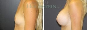 Breast Augmentation Patient