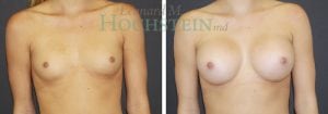 Breast Augmentation Patient