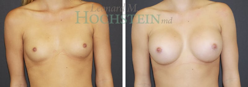 Breast Augmentation Patient