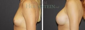 Breast Augmentation Patient