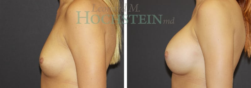 Breast Augmentation Patient