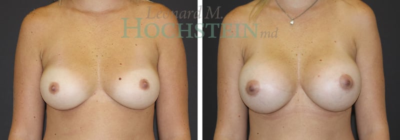 Breast Augmentation Patient
