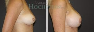 Breast Augmentation Patient