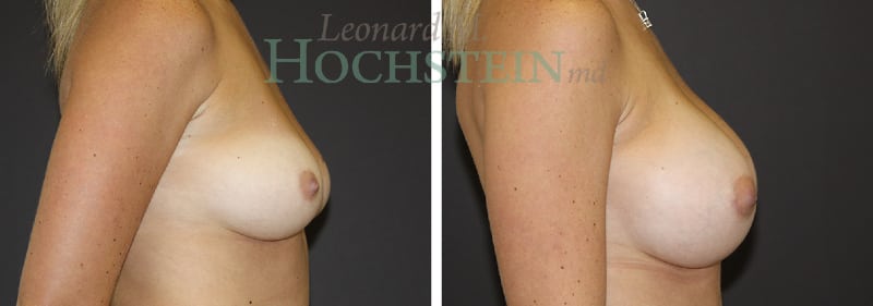 Breast Augmentation Patient