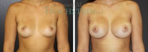 Breast Augmentation Patient