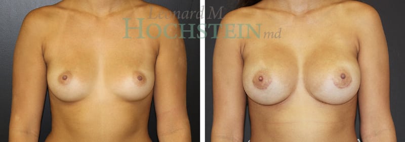 Breast Augmentation Patient