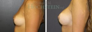 Breast Augmentation Patient