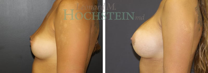 Breast Augmentation Patient