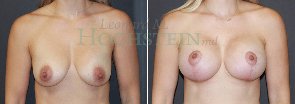 Breast Lift With Implants Patient