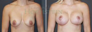 Breast Lift With Implants Patient