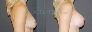 Breast Lift With Implants Patient