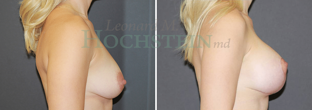 Breast Lift With Implants Patient
