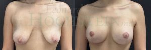 Breast Lift Patient 213