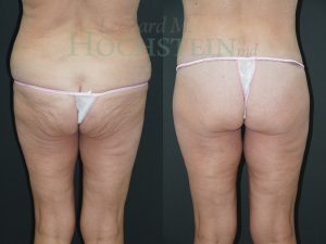 Buttock Lift Patient 02