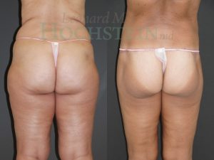 Buttock Lift Patient 03