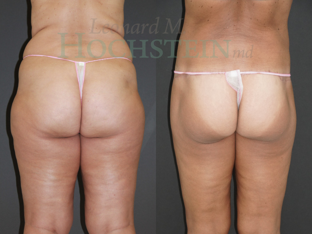 Buttock Lift Patient