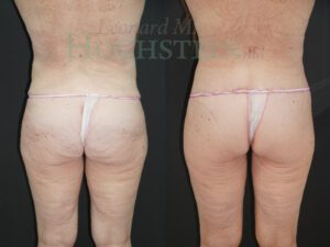 Buttock Lift Patient 04