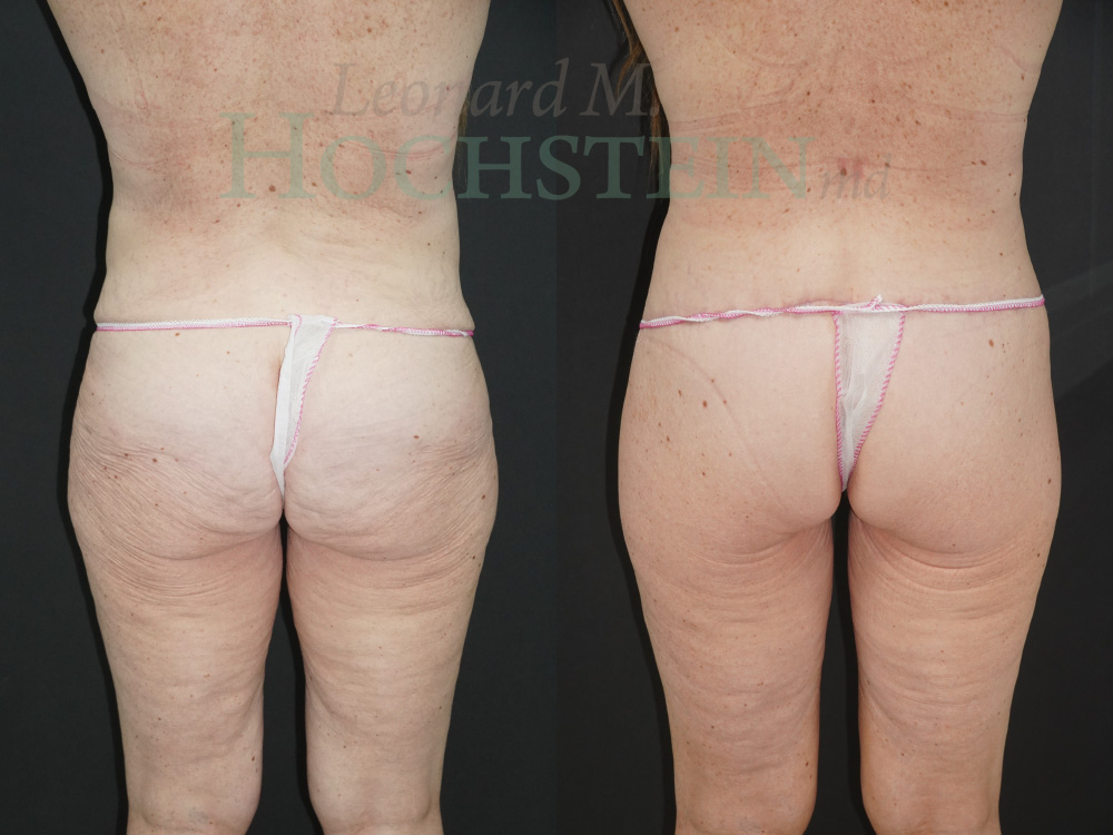 Buttock Lift Patient