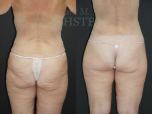 Buttock Lift Patient 05