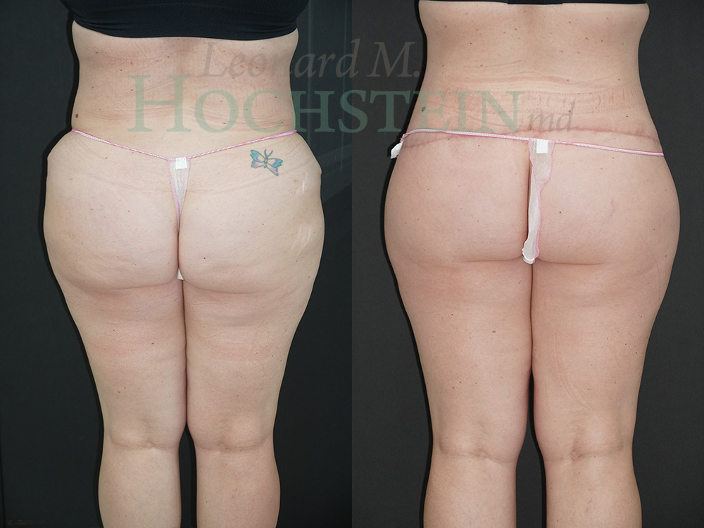 Buttock Lift Patient