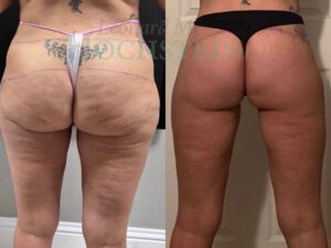 Buttock Lift Patient 1254