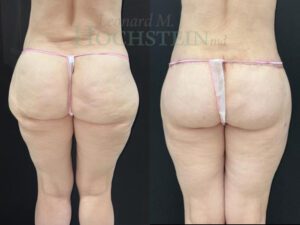 Buttock Lift Patient 8530
