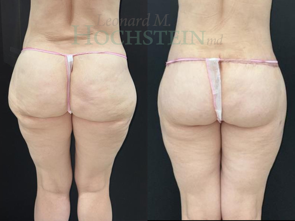 Buttock Lift Patient