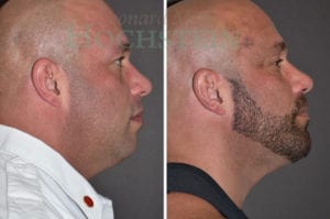 Chin Augmentation Patient