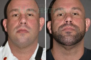 Chin Augmentation Patient 01