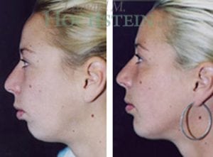 Chin Implant Patient 01
