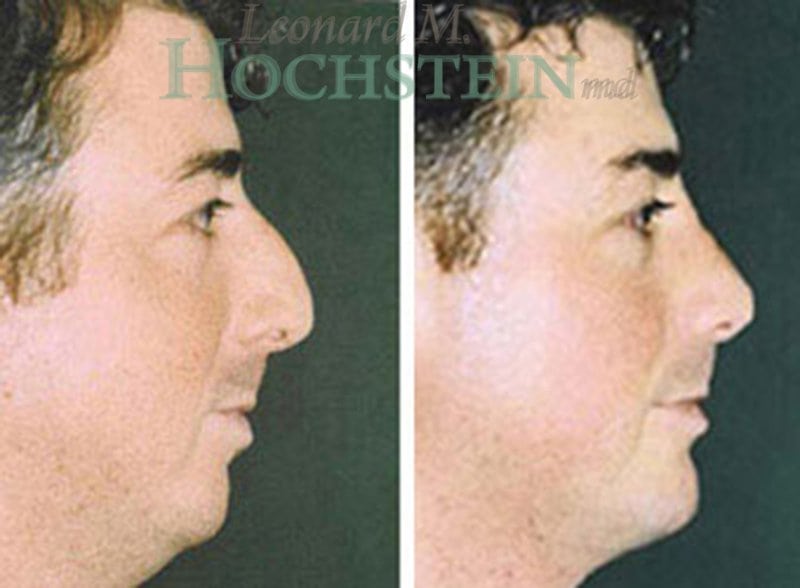 Chin Implant Patient