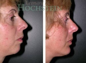 Chin Implant Patient 04