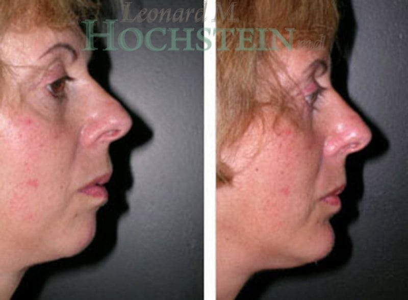 Chin Implant Patient