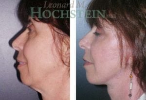 Chin Implant Patient