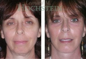 Chin Implant Patient