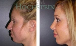 Chin Implant Patient 06