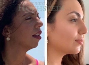 Chin Augmentation Patient 08