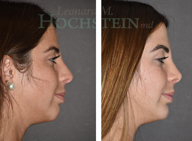 Chin Implant Patient