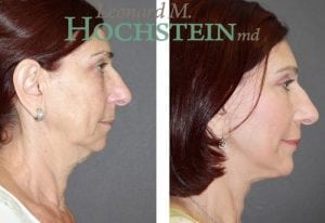 Chin Implant Patient 07