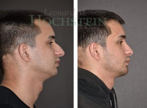 Chin Implant Patient