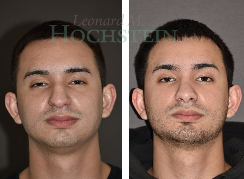 Chin Implant Patient