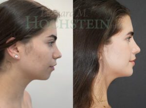 Chin Implant Patient 11