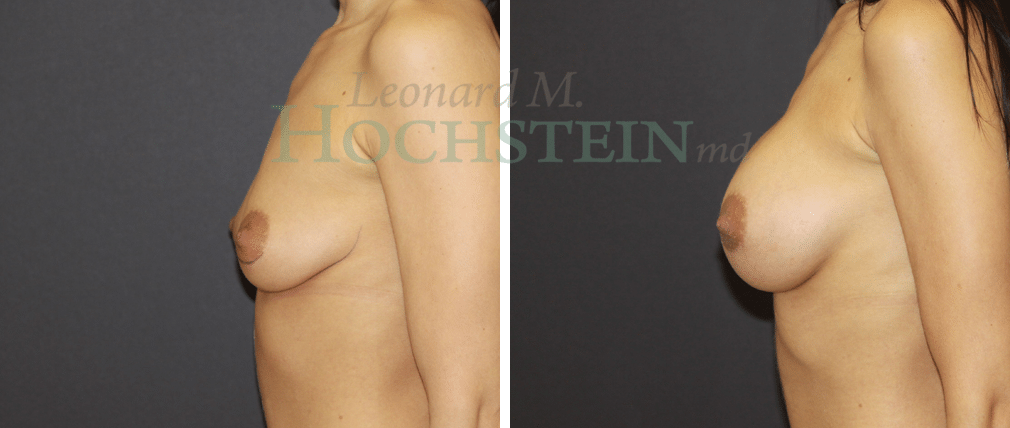 Breast Augmentation Patient