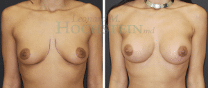 Breast Augmentation Patient