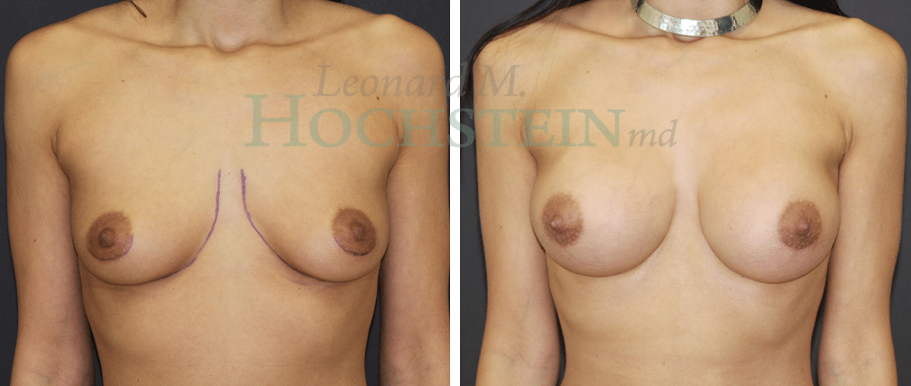 Breast Augmentation Patient