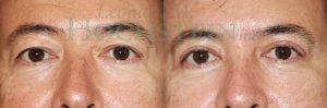 Eyelid Patient 03