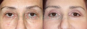 Eyelid Patient 04