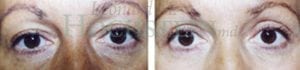 Eyelid Patient 08